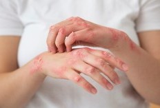Krim Ajaib Penghilang Segala Jenis Masalah Kulit, 10 Kegunaan Dermovate Cream: Hati-Hati Baca Peringatan Jangan Asal Pakai